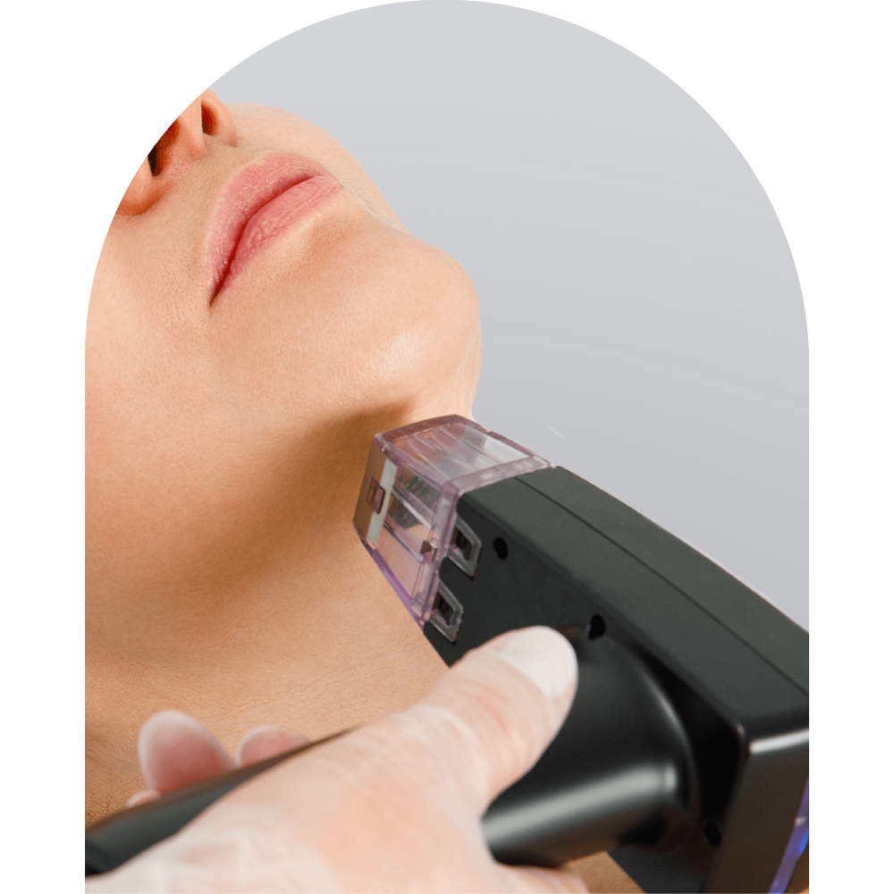 Illustration of a woman receiving a Morpheus8 treatment