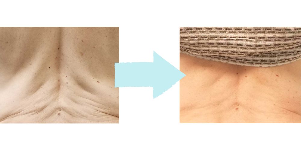 Morpheus8 Body Results – Fort Lauderdale Patient