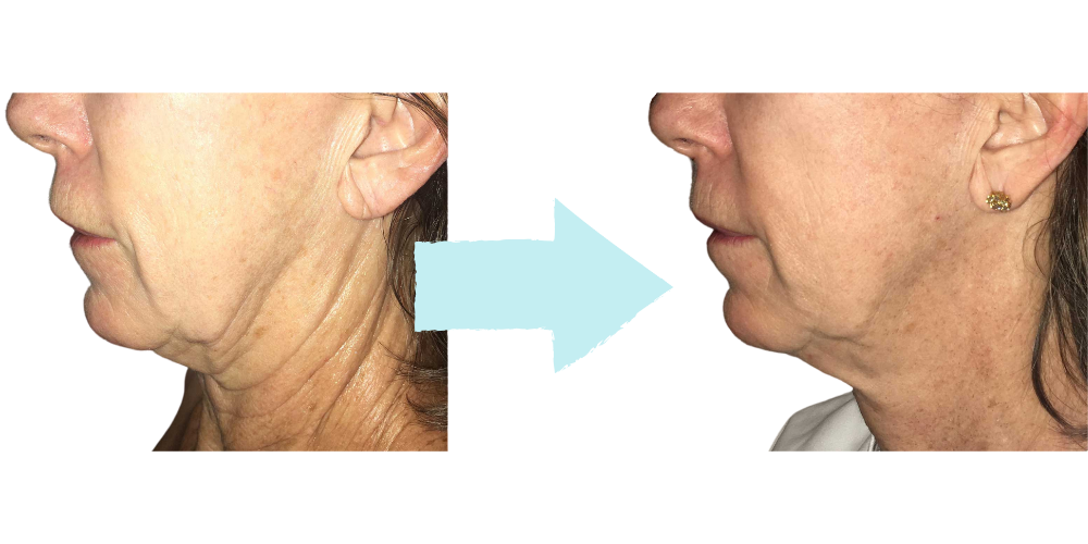 Morpheus8 Neck Results – Fort Lauderdale Patient