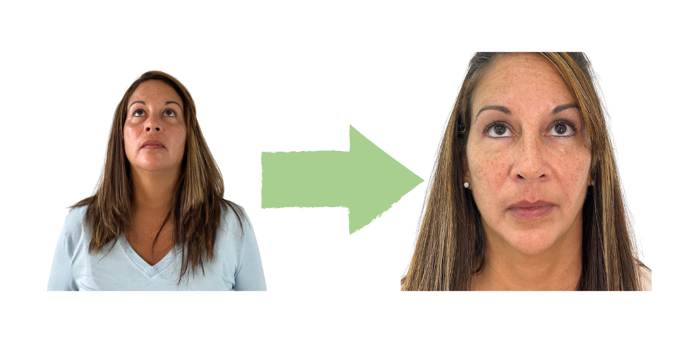 Dermal Filler Results – Fort Lauderdale Patient