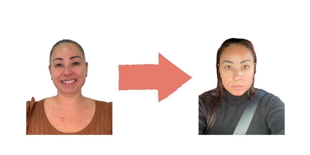 SkinPen Microneedling Face Results – Fort Lauderdale Patient