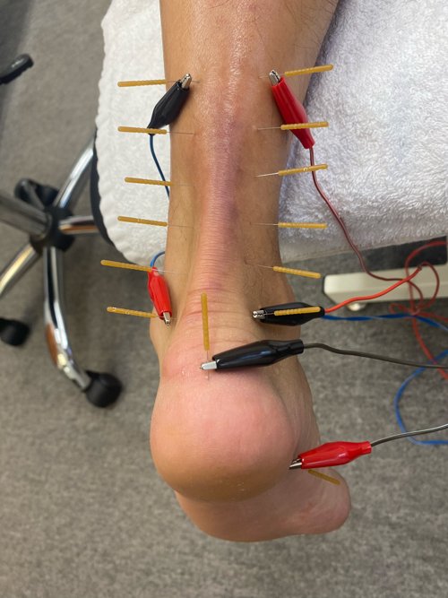 Dry Needling a patients ankle
