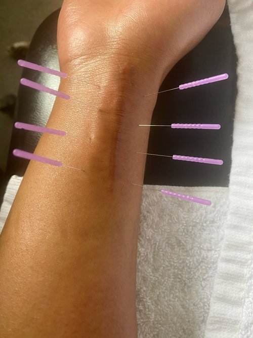 Dry Needling a patients wrist