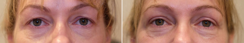 Upper eyelid blepharoplasty-3.png