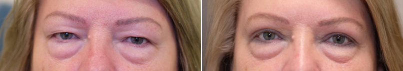 Upper eyelid blepharoplasty-6.png