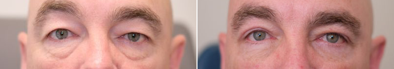 Upper Lower eyelid blepharoplasty-3.png