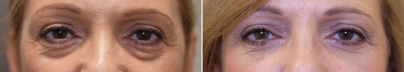 Lower eyelid blepharoplasty-1.png