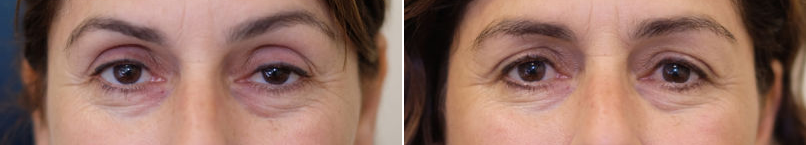Upper eyelid ptosis surgery-1.png