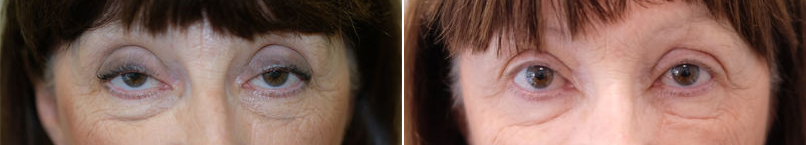 Upper eyelid ptosis surgery-2.png