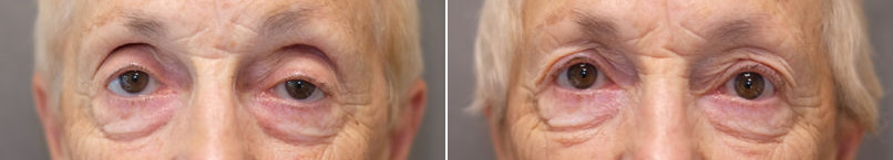 Upper eyelid ptosis surgery-3.png