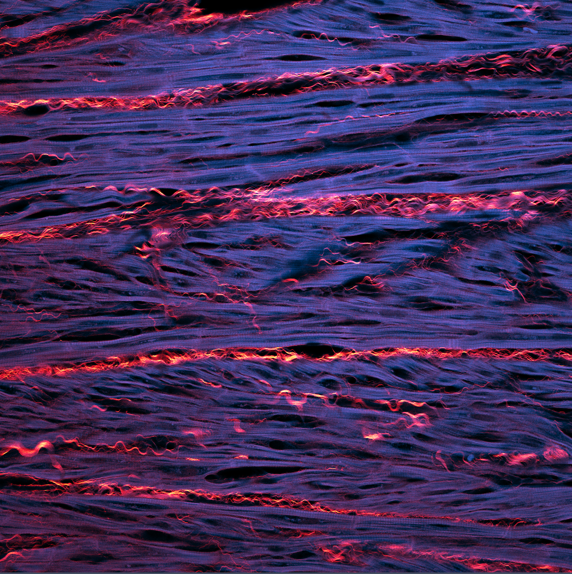 Picosirius Red Staining of Collagen in Human Left Ventricular Myocardium taken on Zeiss 980 with Airyscan 2 at 20x