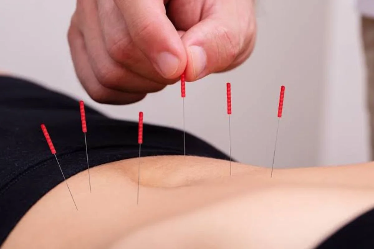 Acupuncture vs Fertility Drugs – What are the Differences?