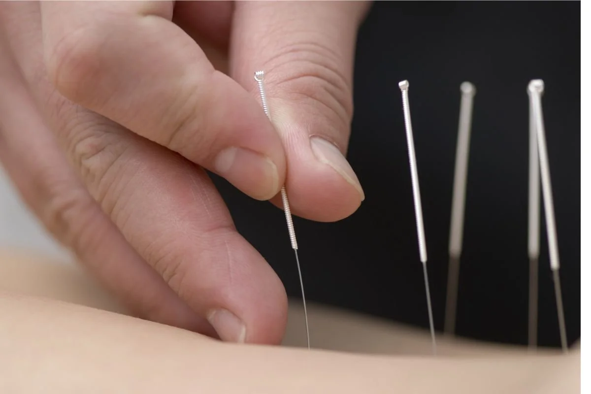 What are the Benefits of Acupuncture Before and After Embryo Transfer?
