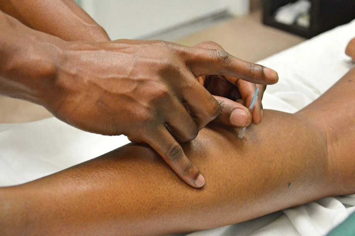 Acupuncture for IVF in Houston