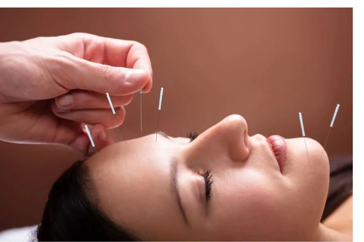 Acupuncture Before and After Embryo Transfer