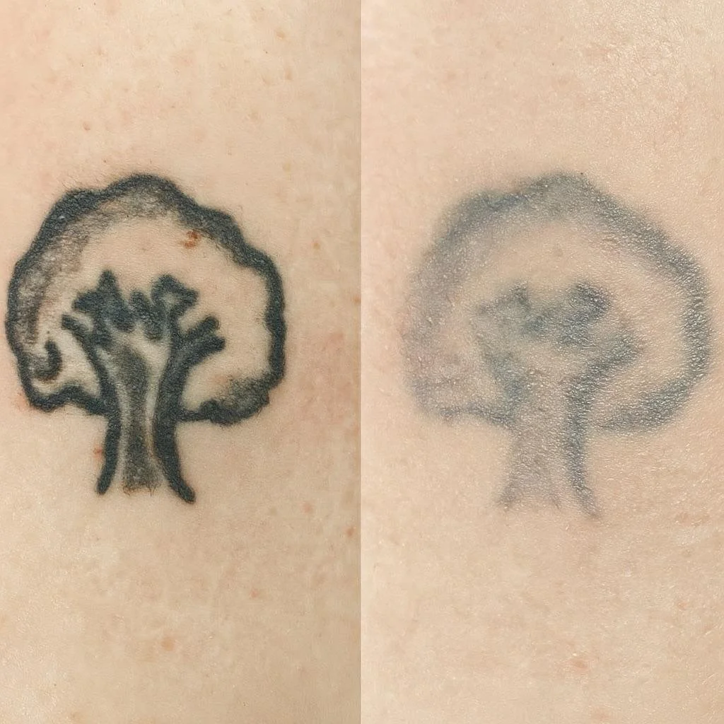 tattoo-removal-example2.jpg