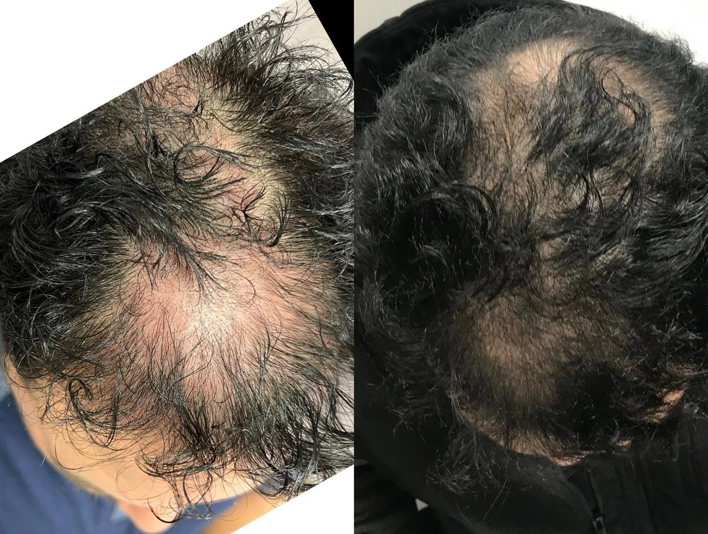 Hair-Restoration-Example-6.jpg