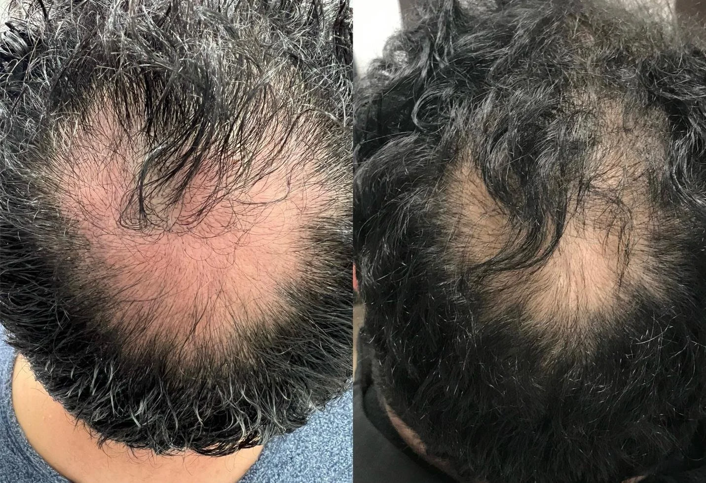 Hair-Restoration-Example-7.jpg