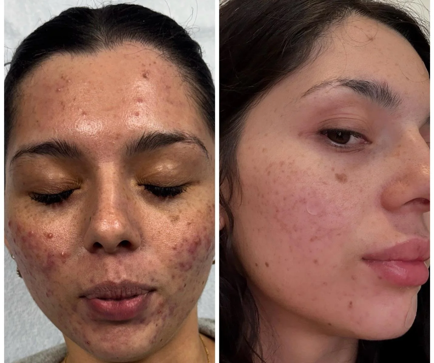 microneedling-example-4.jpg