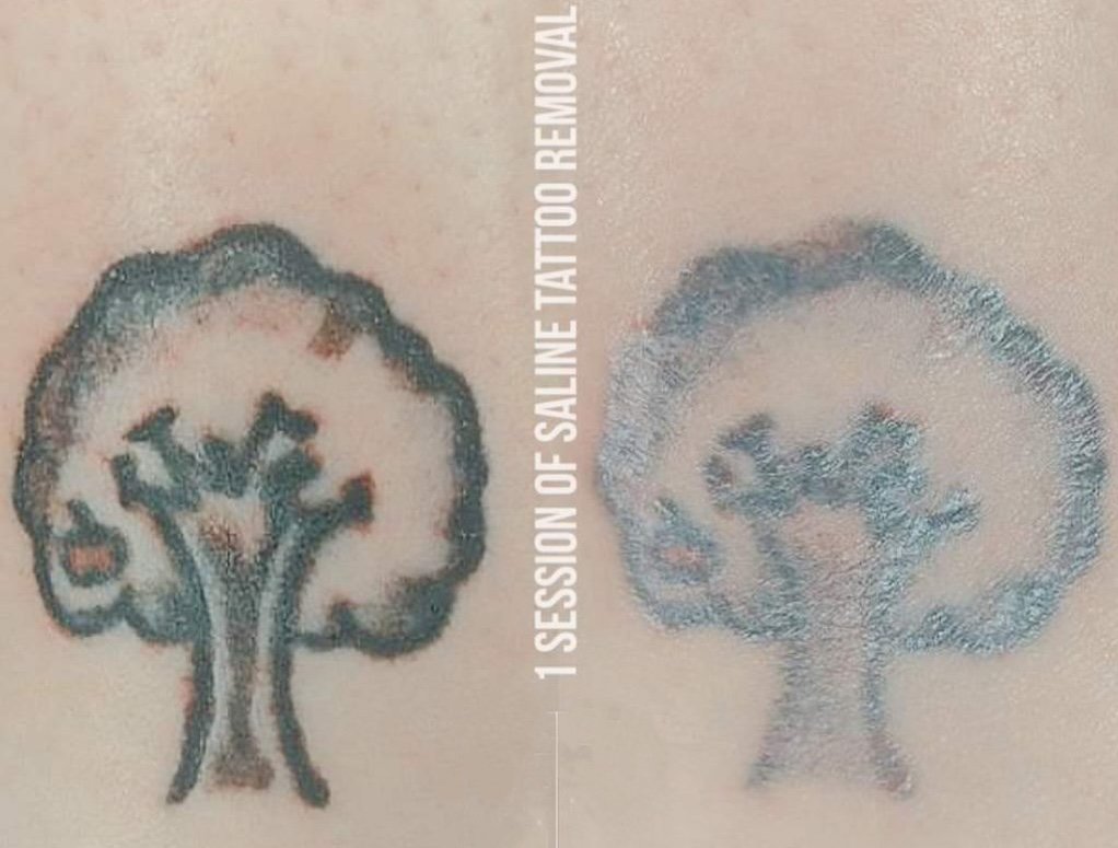 Tattoo Removal  BEACH CITY BROWS