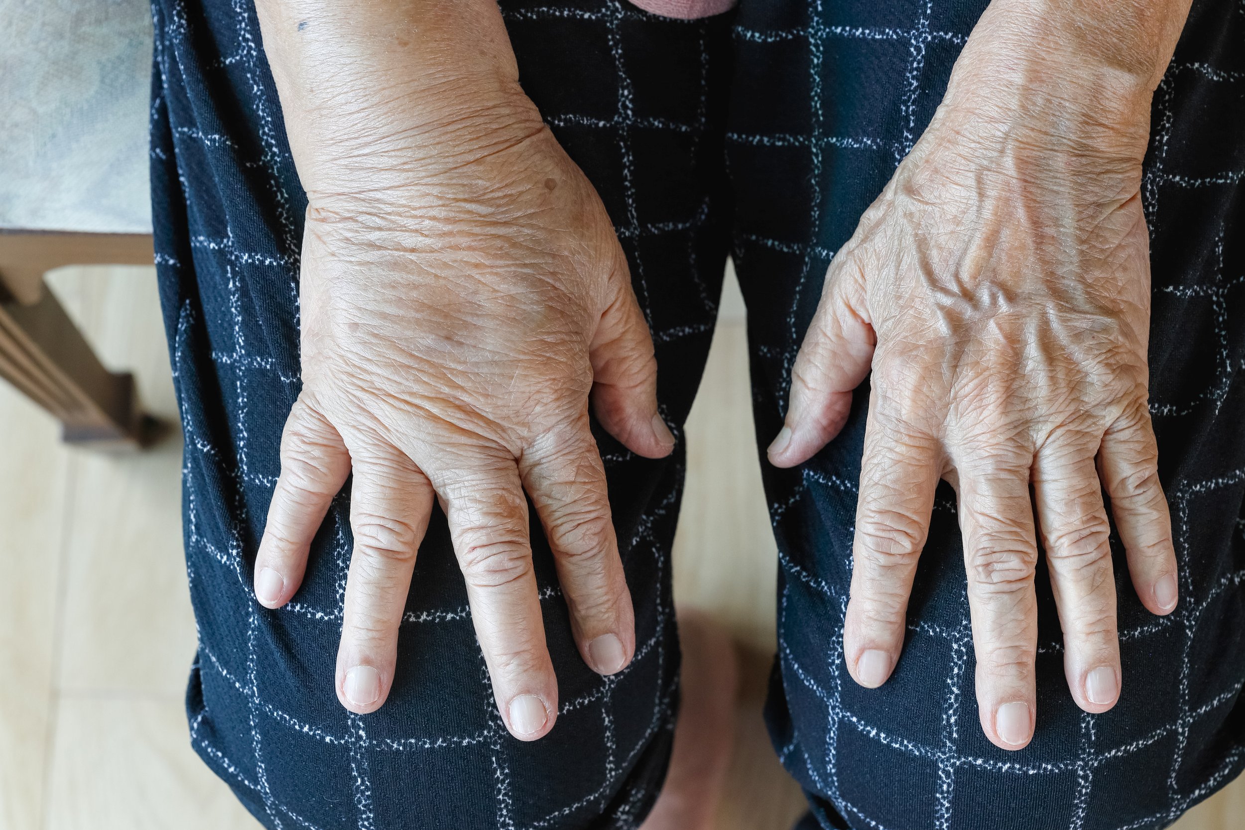 right Hand lymphedema next to left hand without lymphedema. resting on blue striped shorts