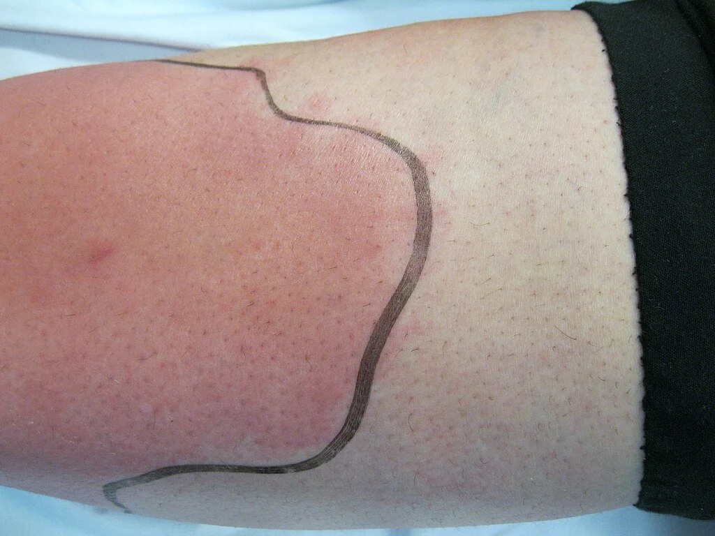 The Cellulitis-Lymphedema Link: Everything You Need to Know - Cancer ...