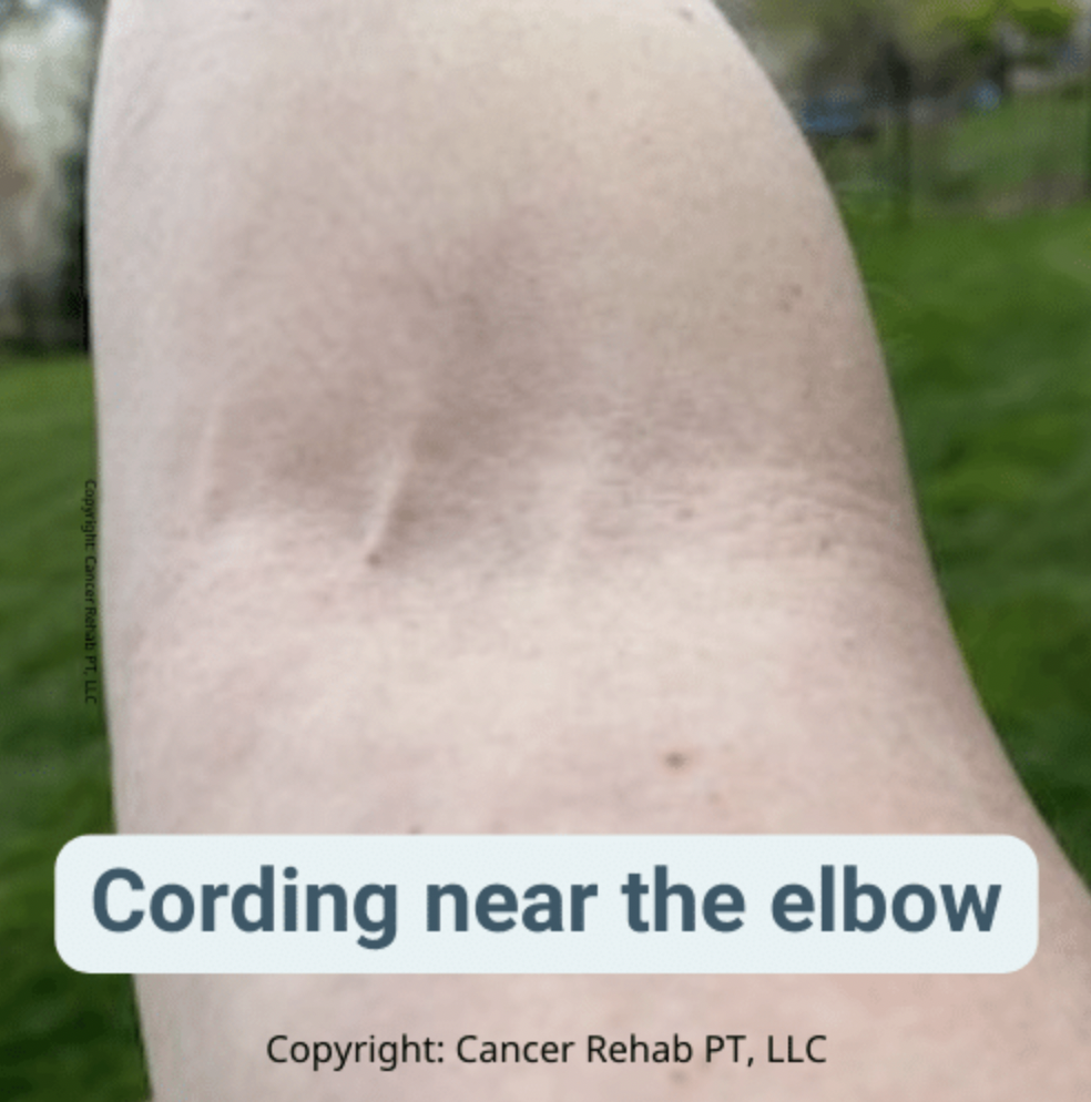 Cording near the elbow.