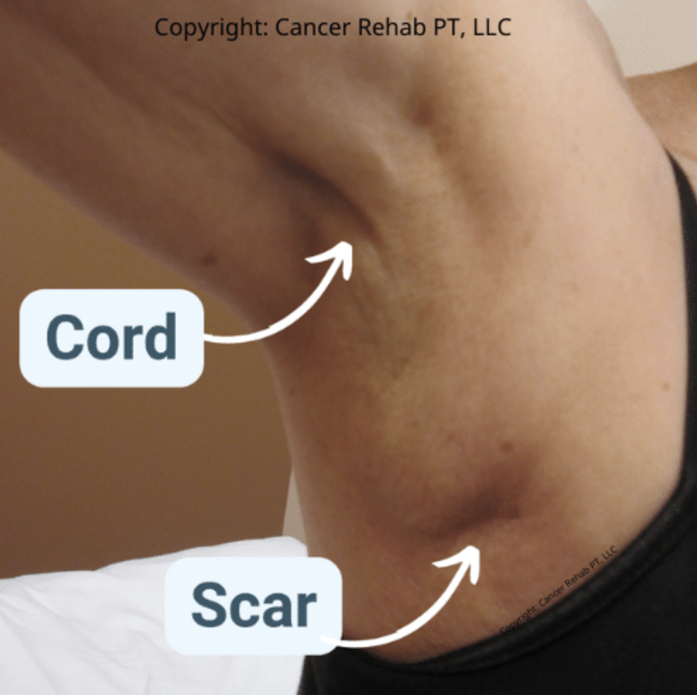 Cancer Rehab PT — How to Get Rid of Cording After Mastectomy A Guide