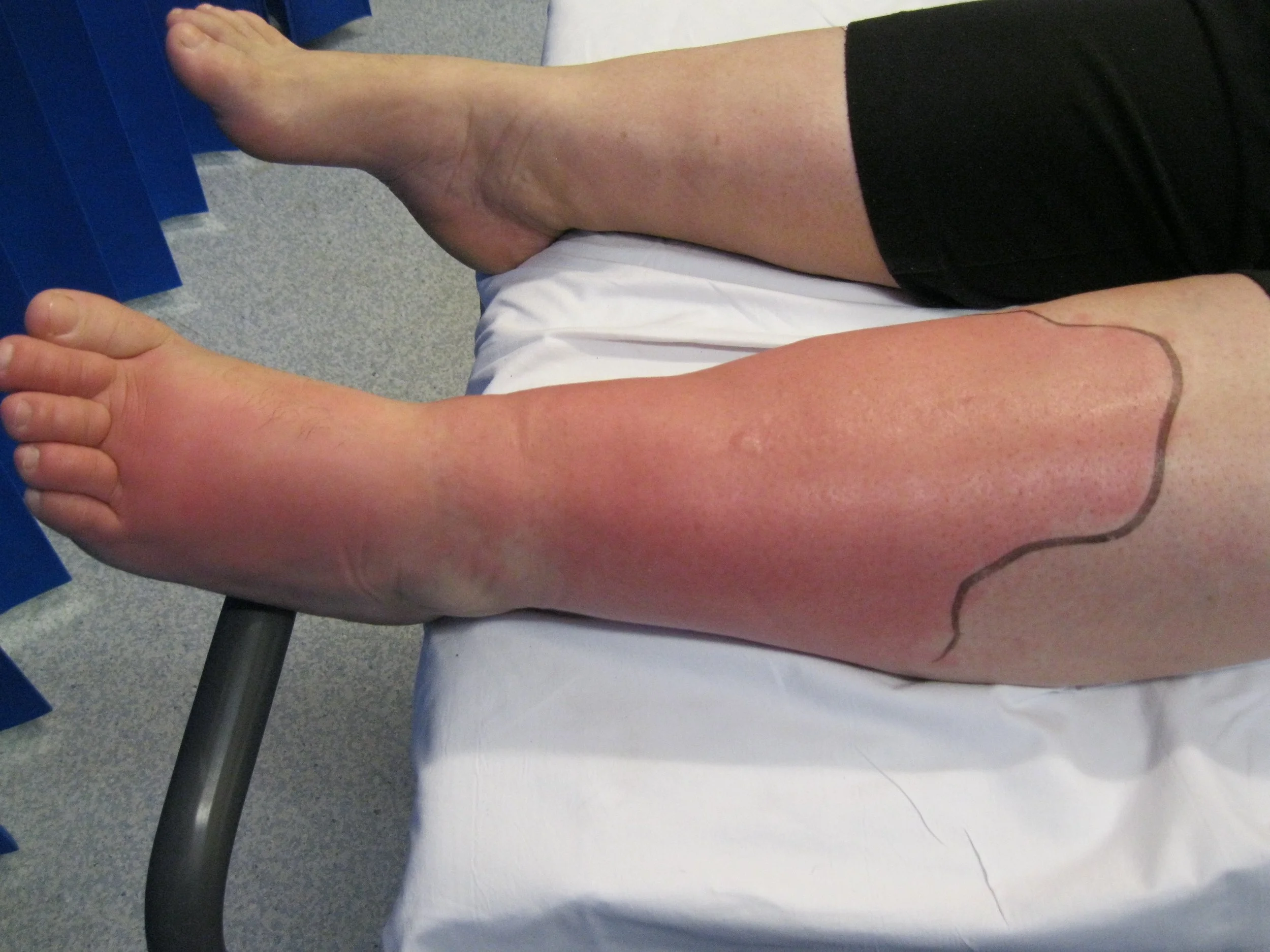 Cancer Rehab PT — The Cellulitis-Lymphedema Link: Everything You Need ...