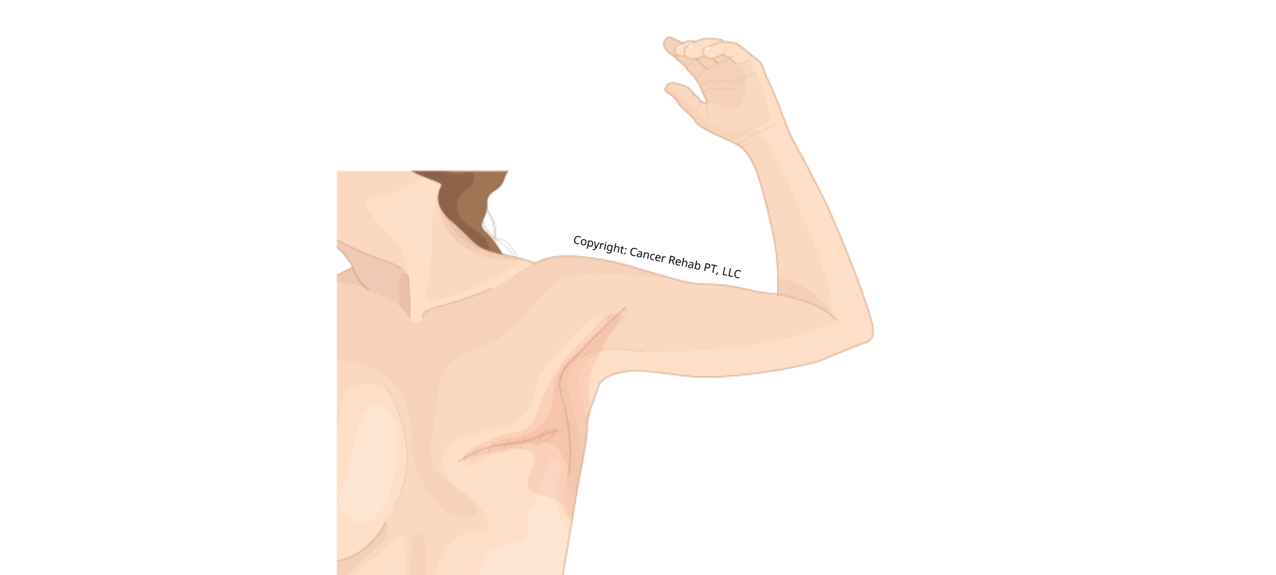 cancer-rehab-pt-side-effects-of-radiation-for-breast-cancer-what-to-do
