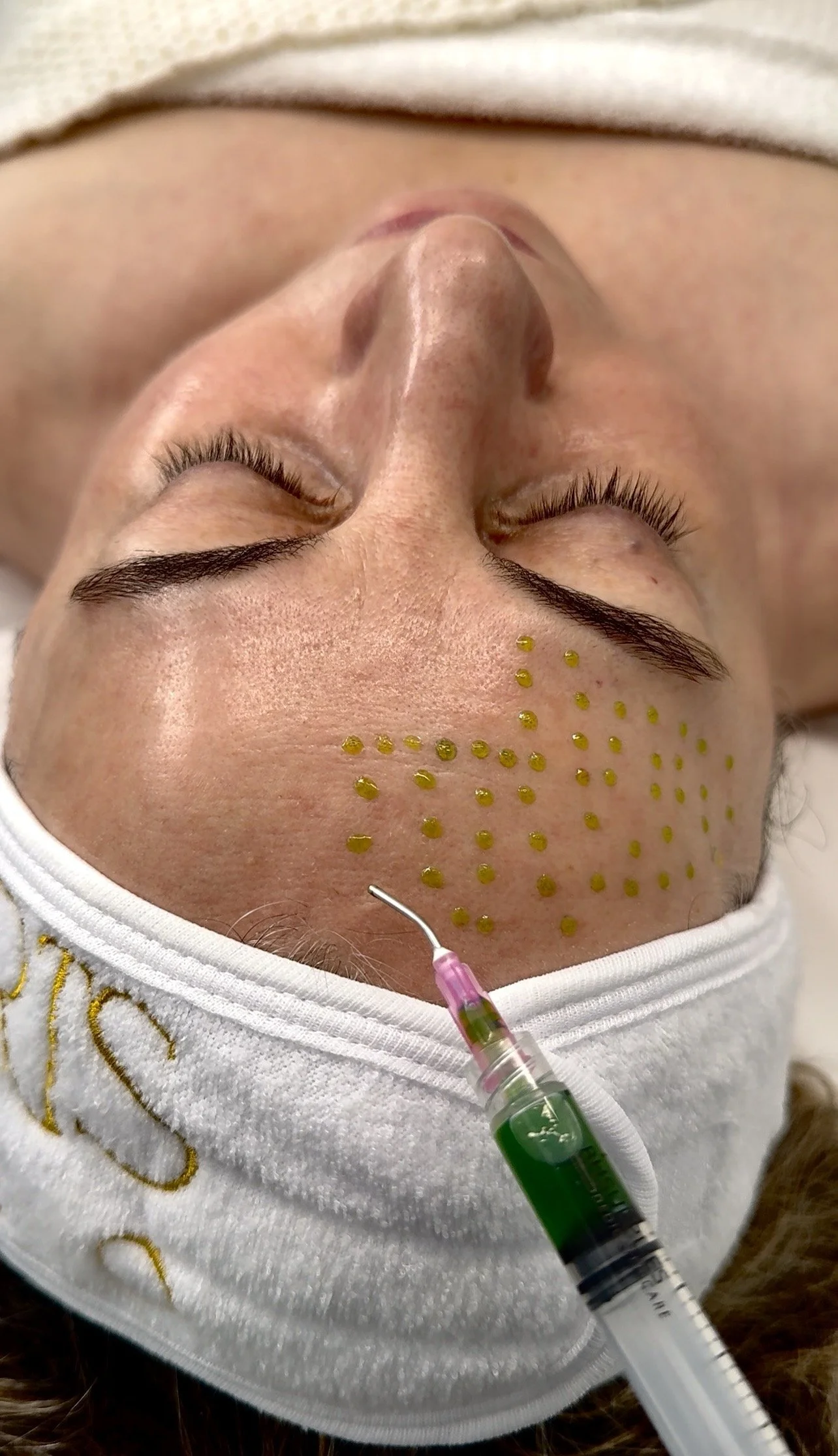 Chemical Peels, Face Reality Peel, Skinceuticals Peels, Alumier Peels, Pigment Balancing, Micropeel, Acne Peel, Glycolic peel, Salicylic Peel, Advanced Peel, VI Peels