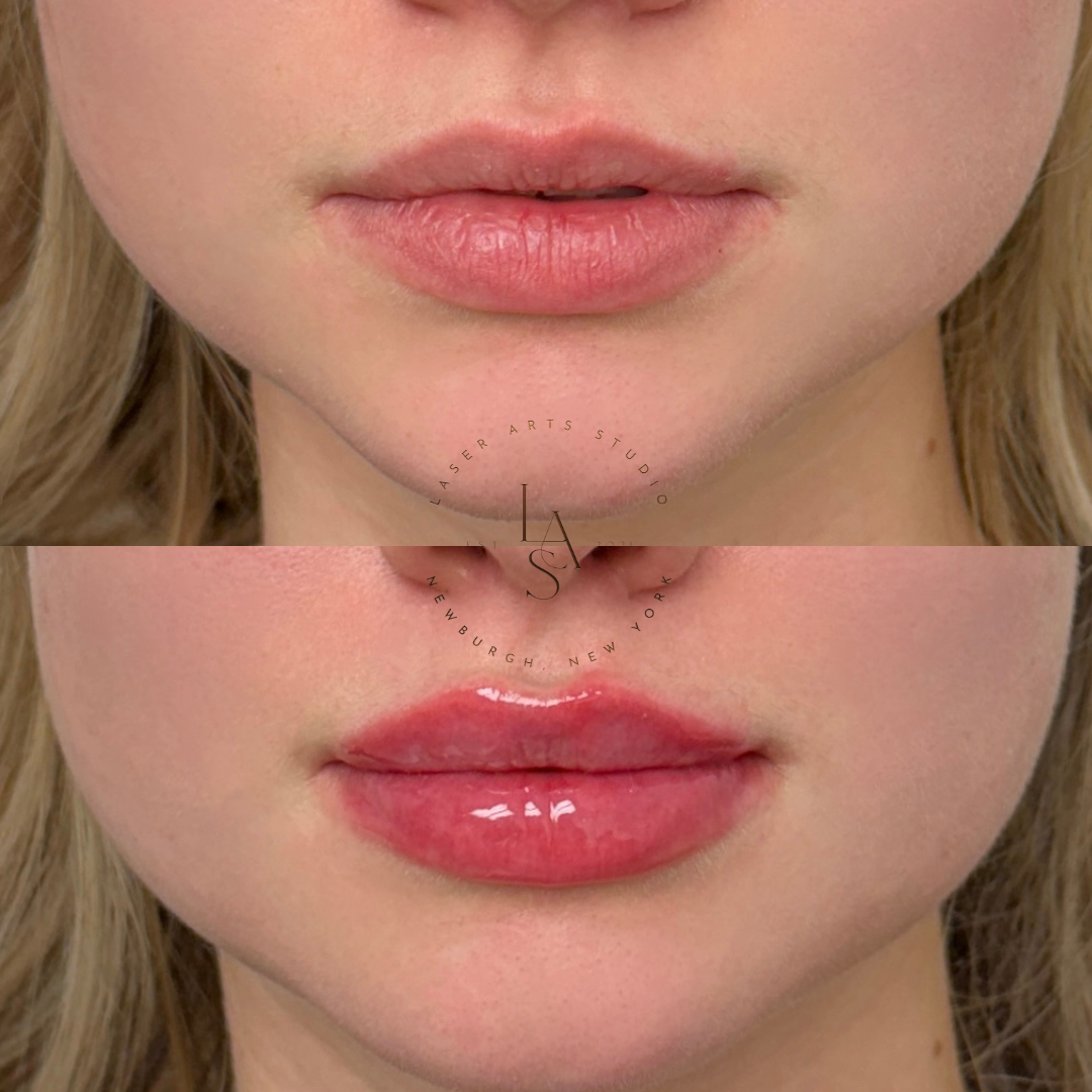 Close-up of a person's lips, showing a before and after comparison of lip enhancement or makeup application. The top image shows natural lips, while the bottom image shows glossy, well-defined lips.