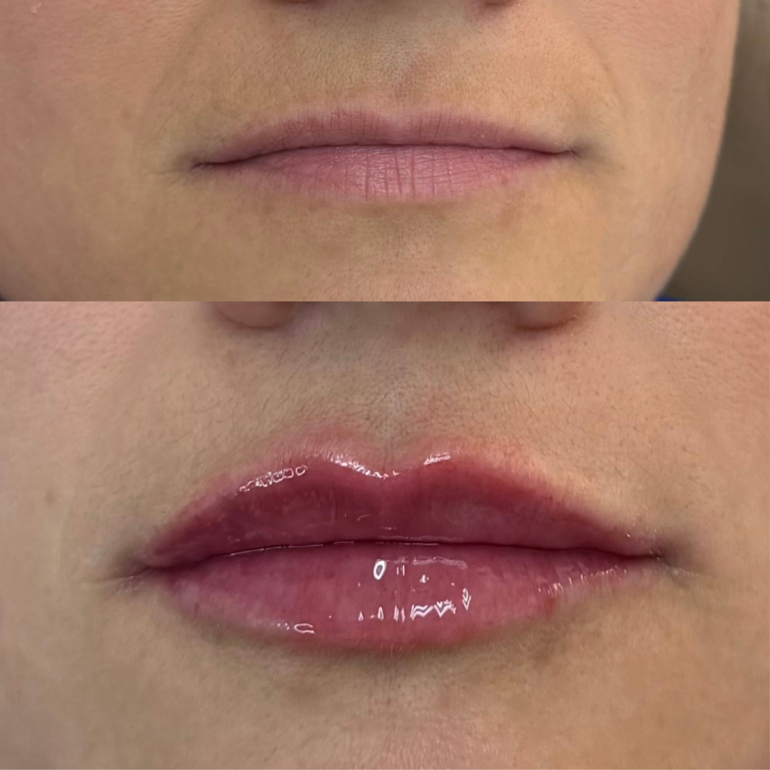 Lips Before and After Photos.png.png