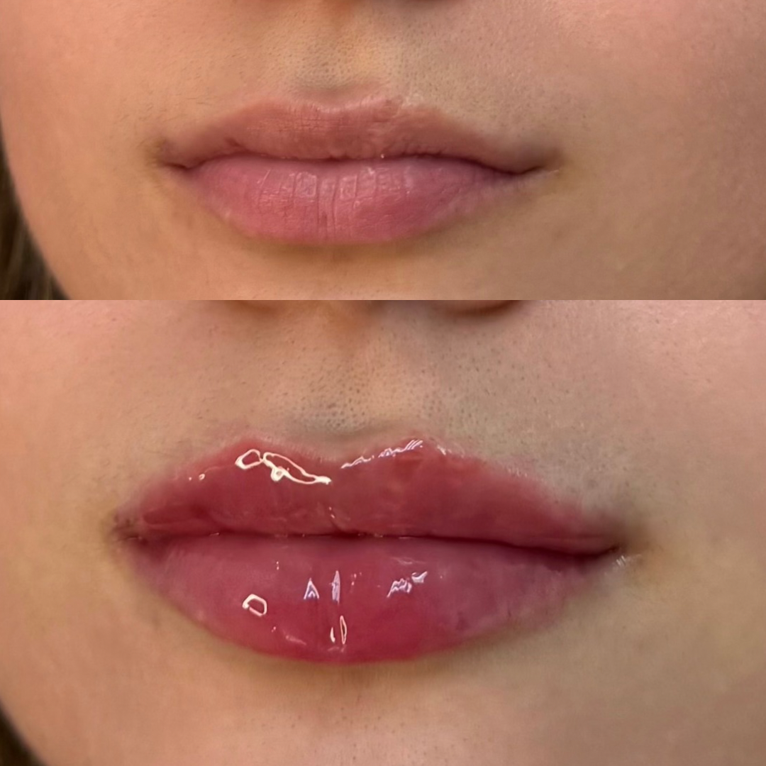 Lips Before and After Photos.png