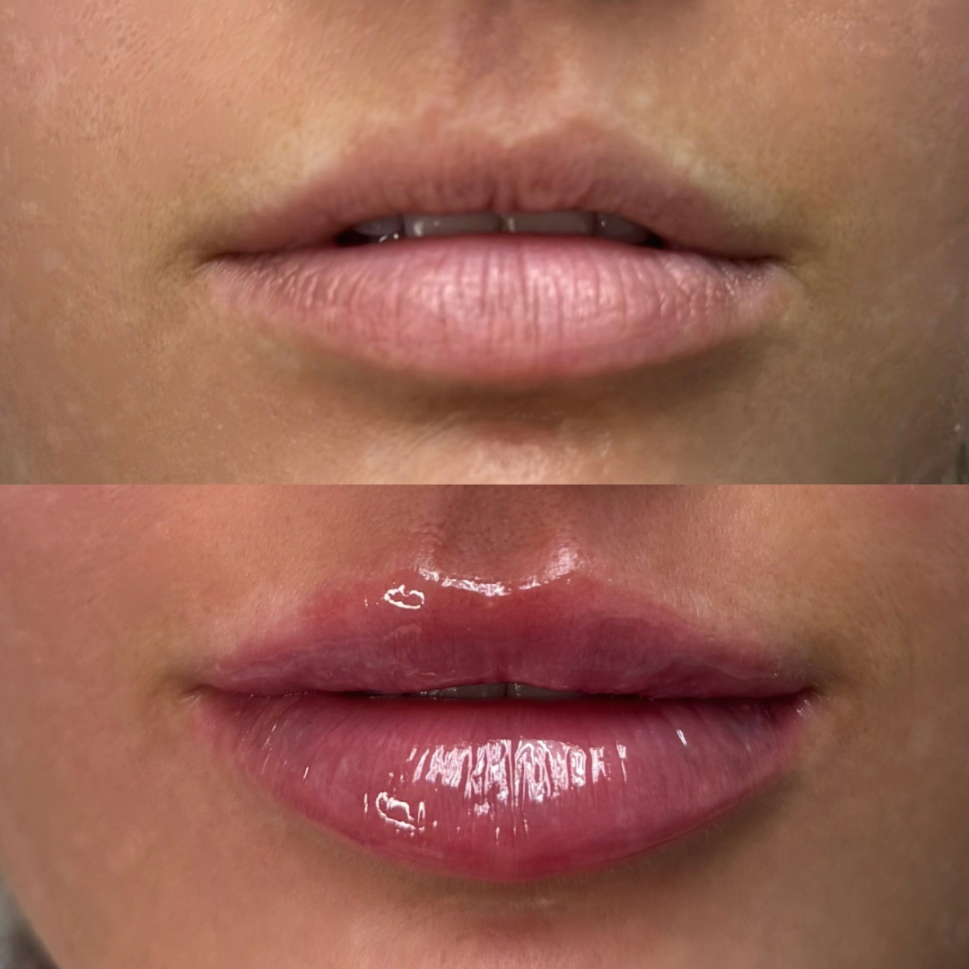 Lips Before and After Photos.png