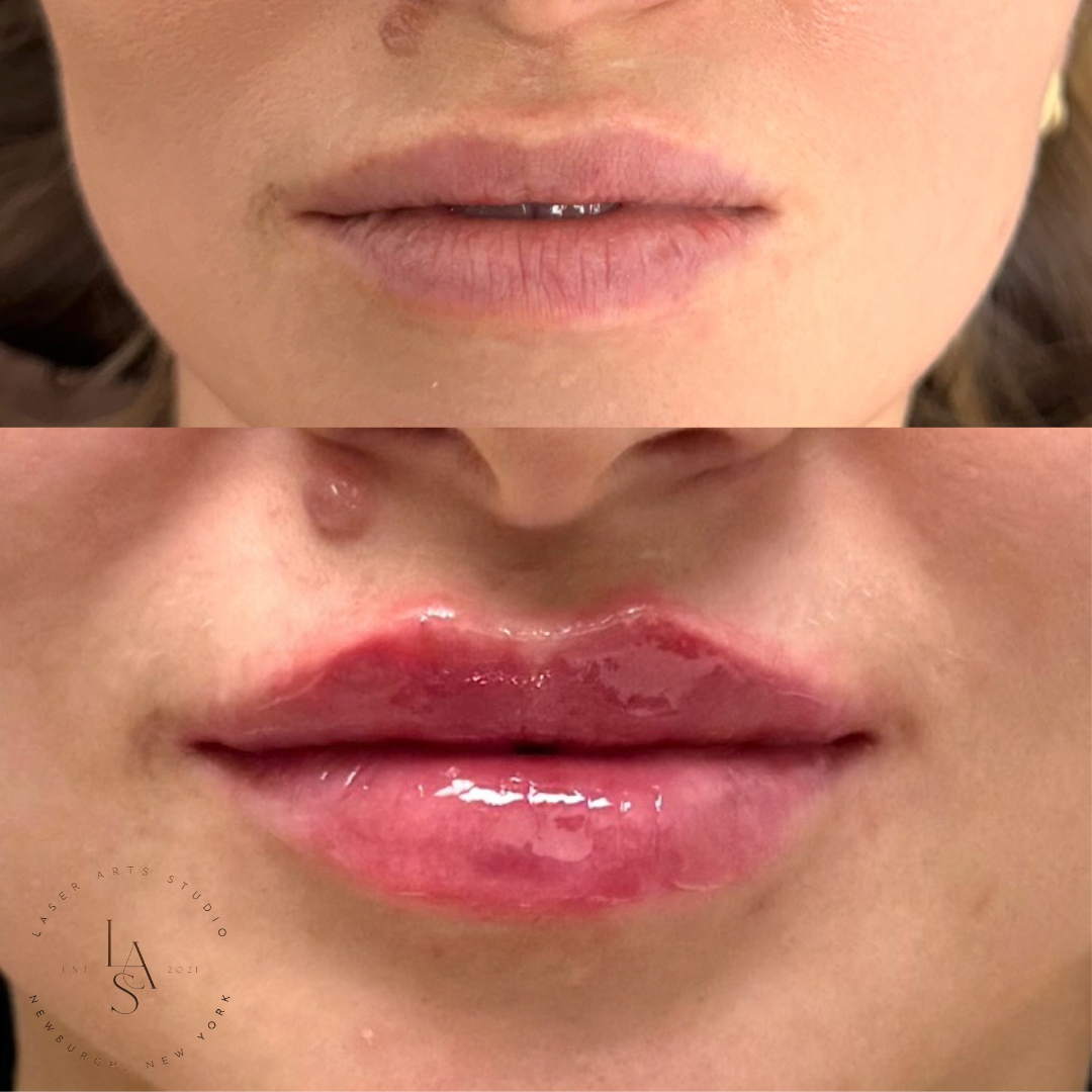 Lips Before and After Photos.png.png