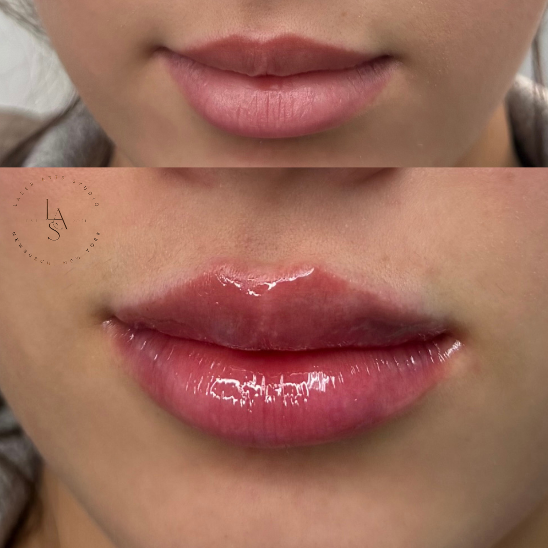 Lips Before and After Photos.png.png