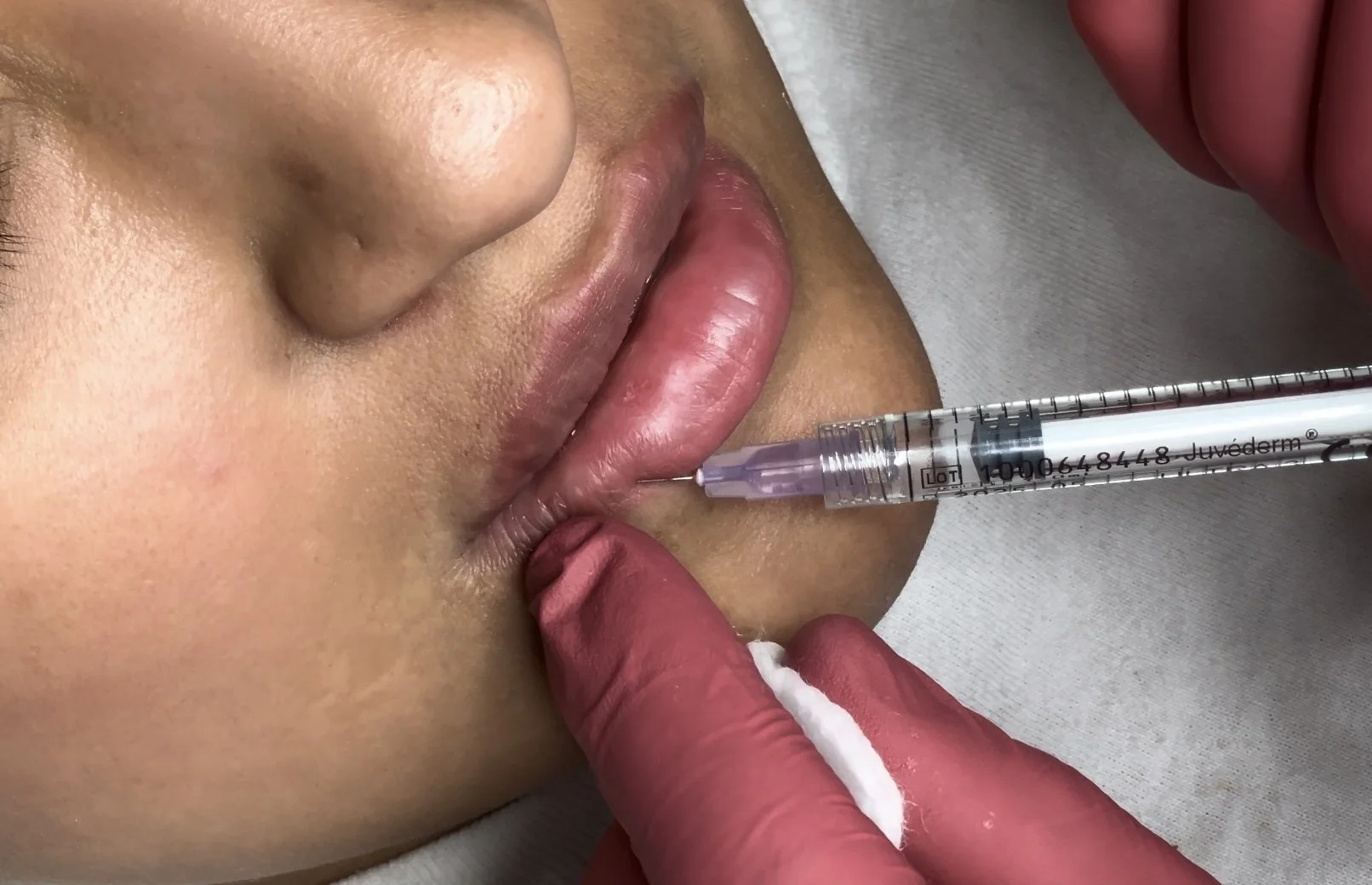 Dermal Filler FAQs