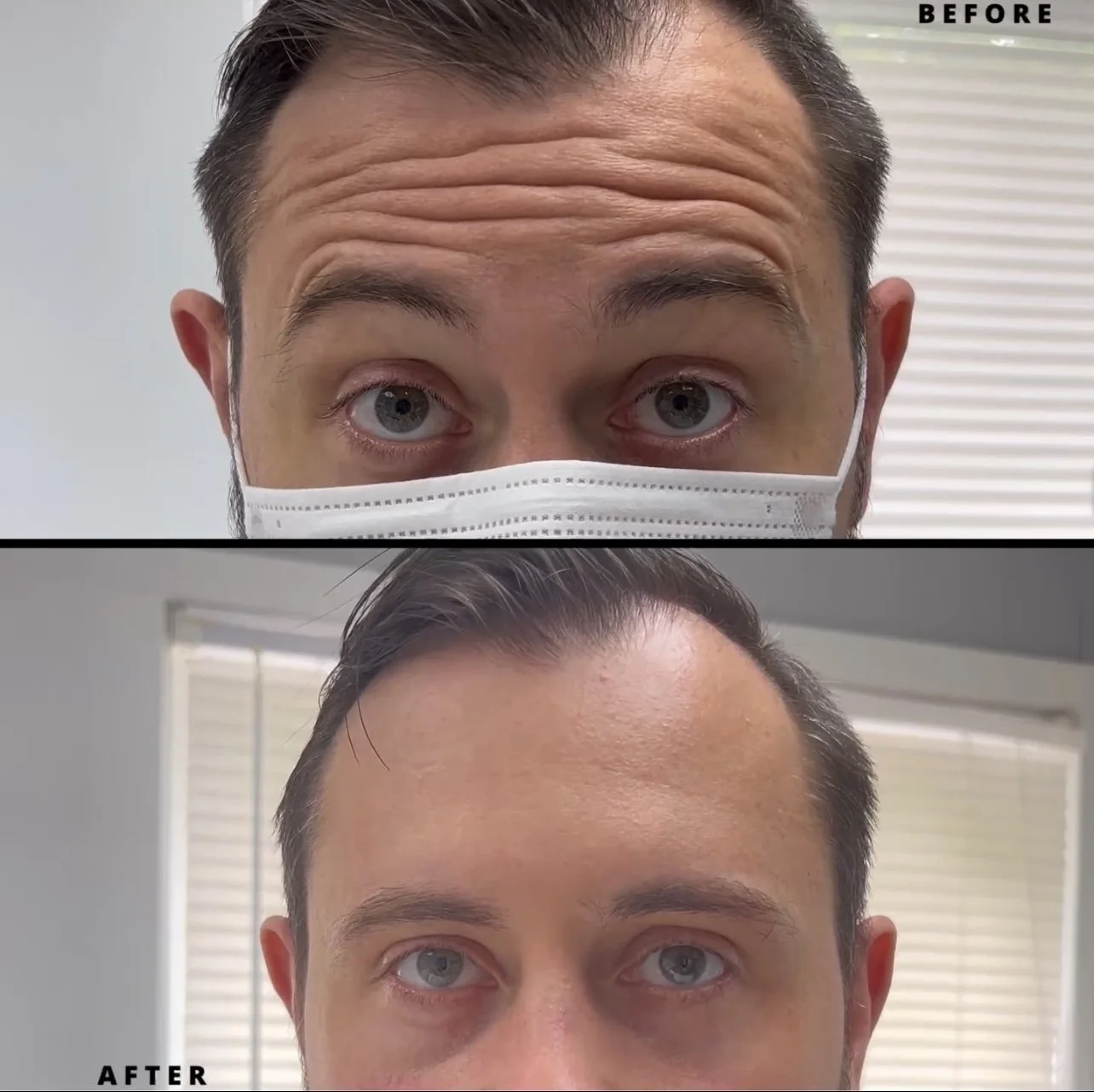 Botox, Botulinum Toxin, TMJ, Forehead, Glabella 11s, Crow's Feet, Bunny Lines, Chin, Sweating, Hyperhydrosis Botox, Smoker's Lines