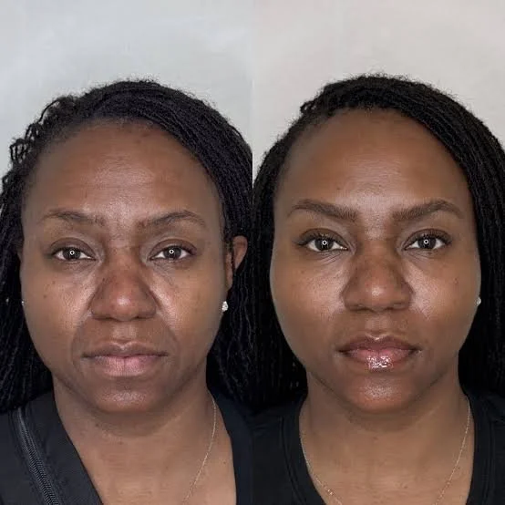 Superficial skin epidermal injections skin rejuvenation, Monaco cocktail, therapy, medspa, injectables