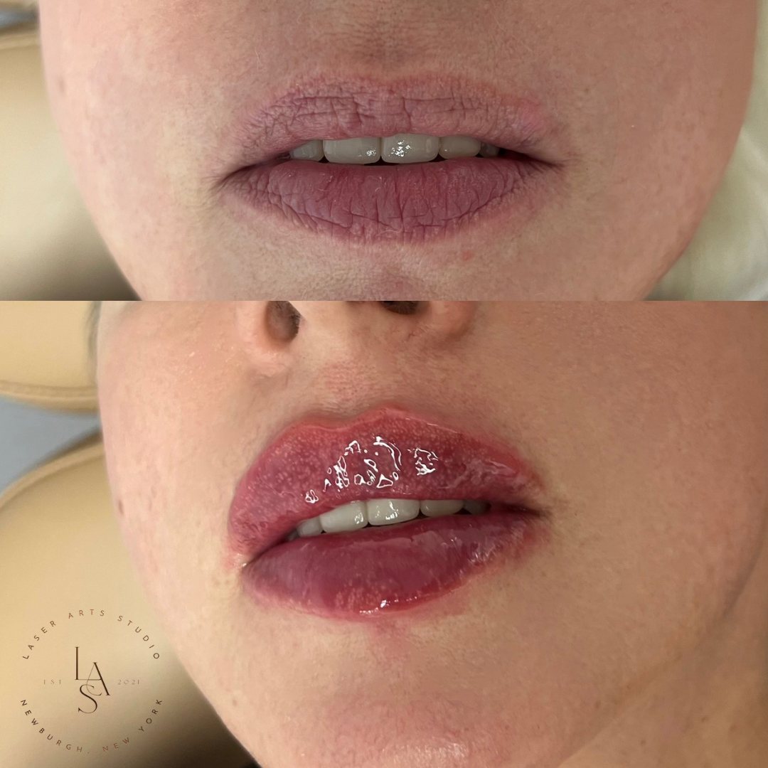 Lips Before and After Photos (1).PNG