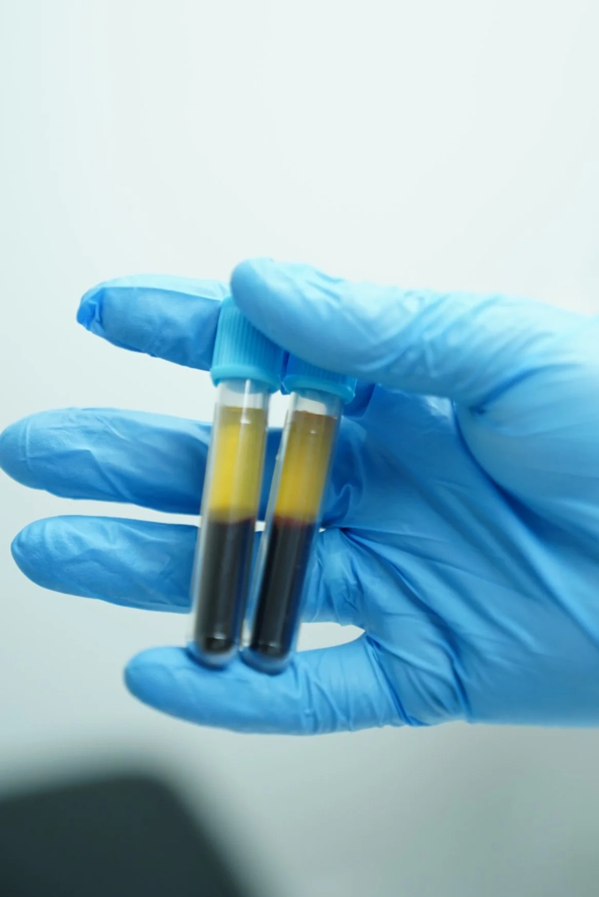 Platelet-rich Plasma, injections, plasma hair restoration, skin rejuvenation, skin tightening, skin healing, blood vampire facial