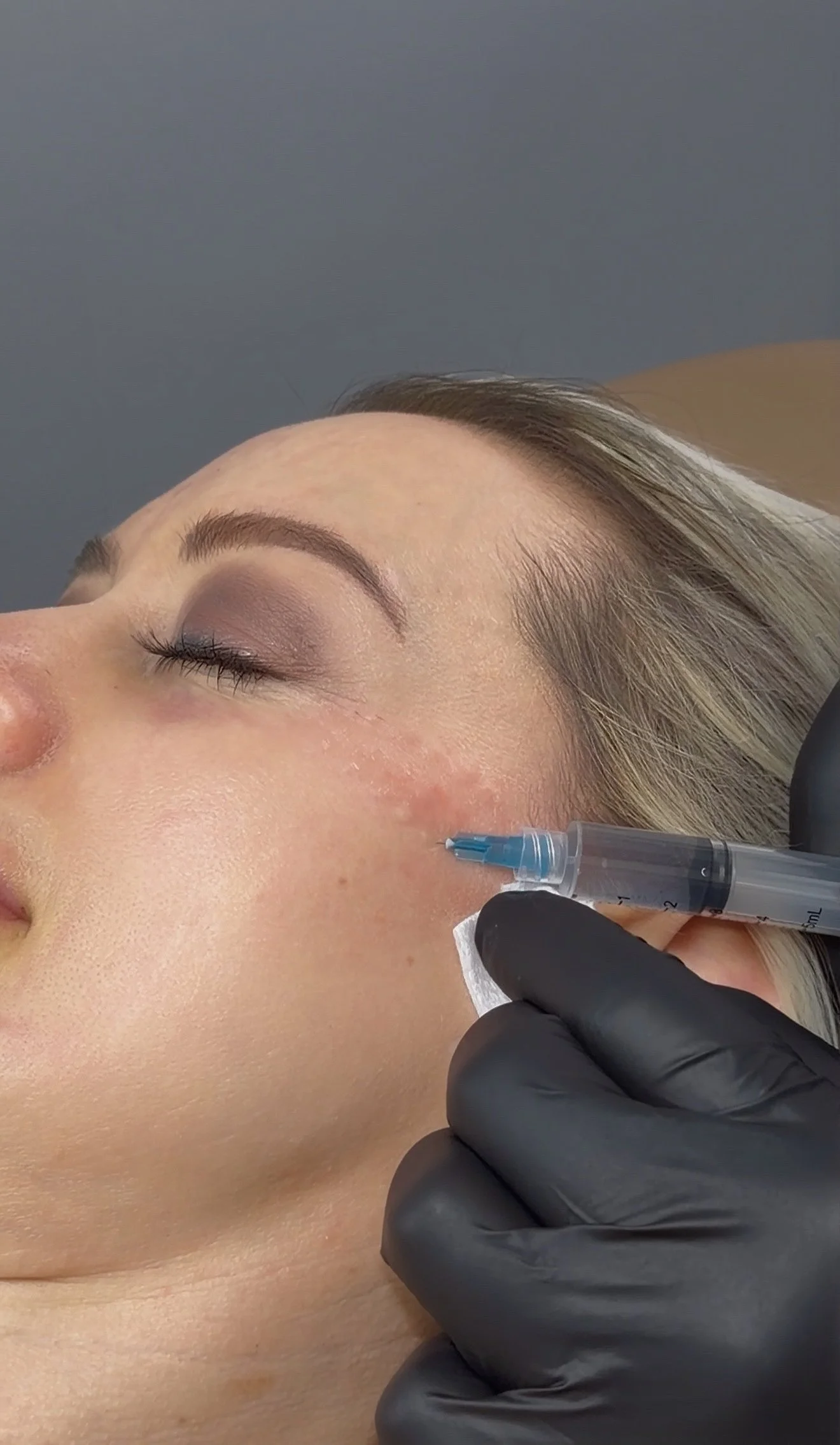 A woman lying with her eyes closed, getting a cosmetic injection in her cheek, with a medical professional wearing black gloves using a syringe.