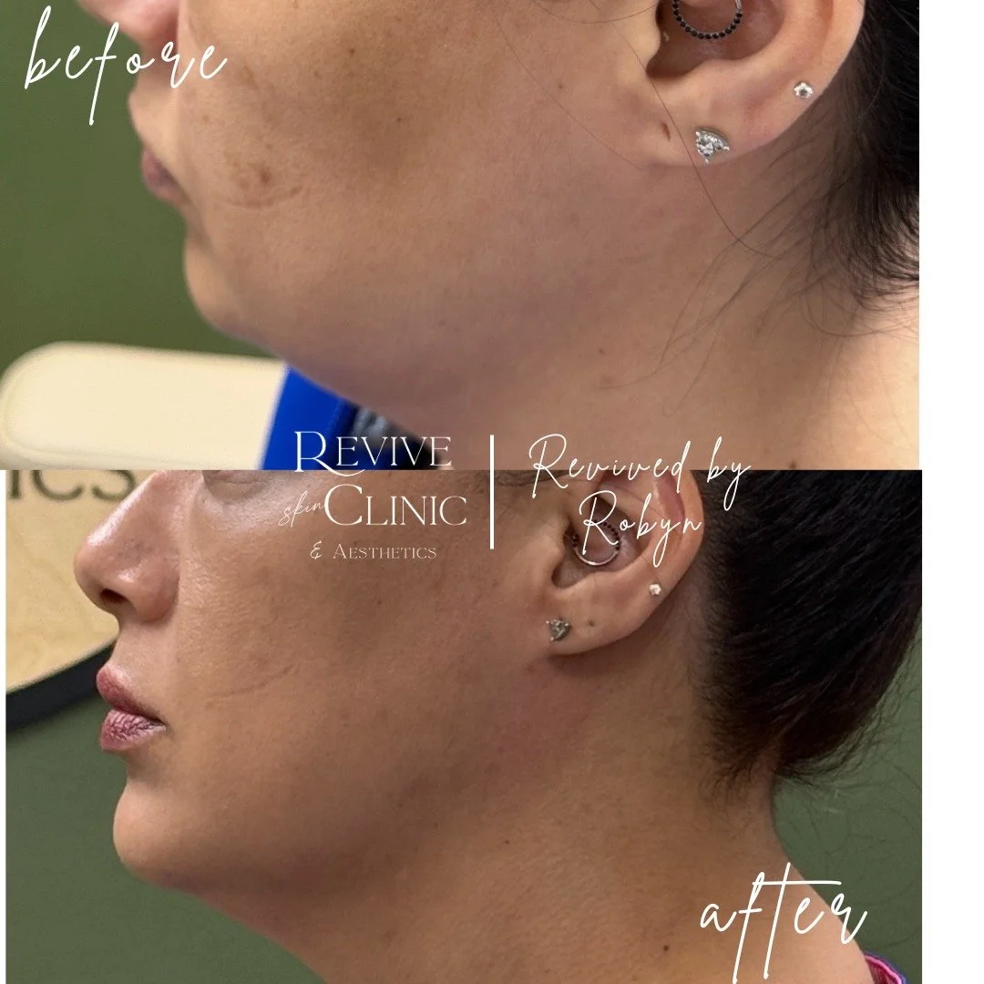 The Results Speak for Themselves ✨
Our patients are loving their Endolift transformations &mdash; and we can see why! 💫

These before &amp; after photos show just how powerful this non-surgical skin tightening treatment can be. With minimal downtime