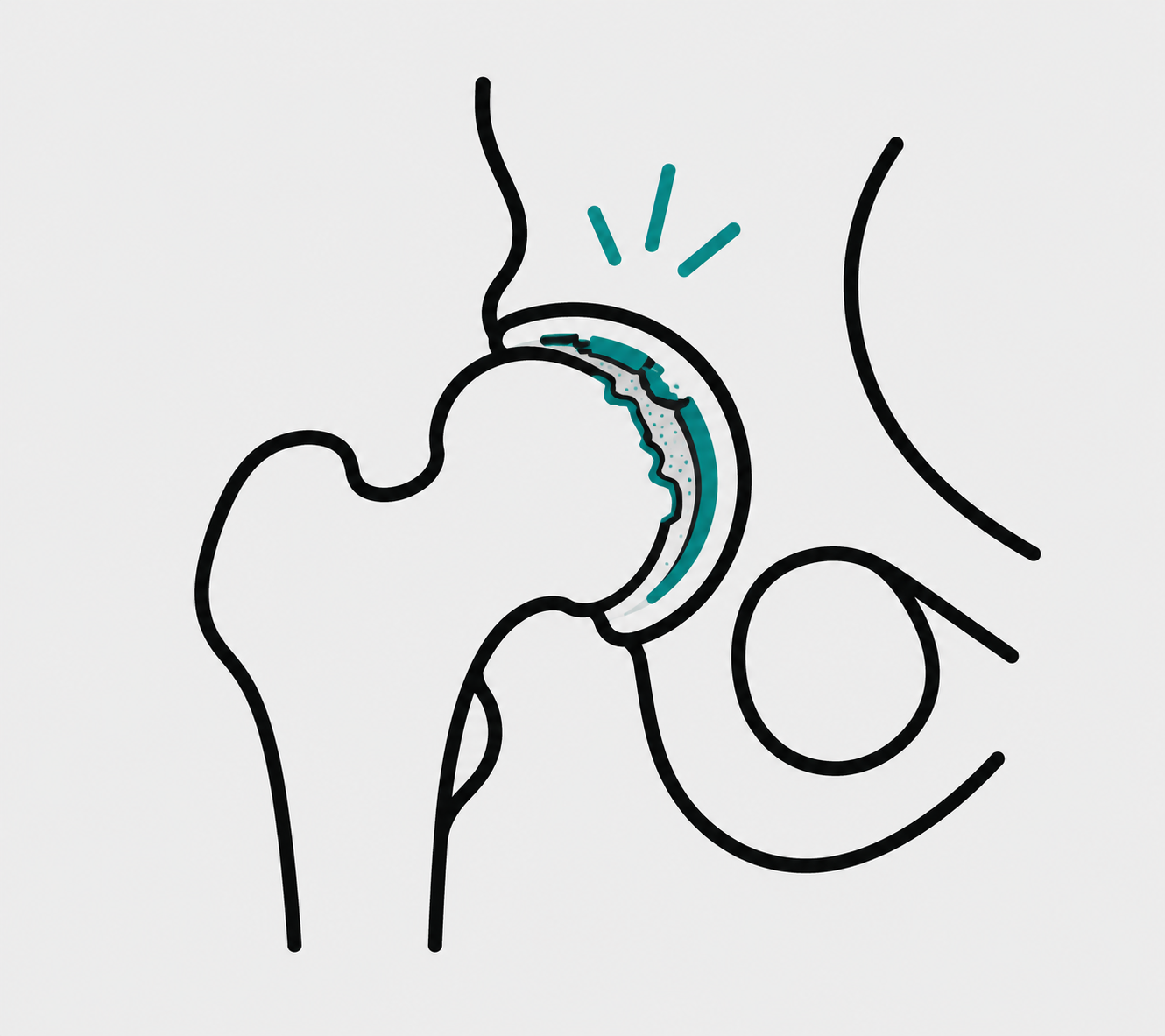 Hip Osteoarthritis