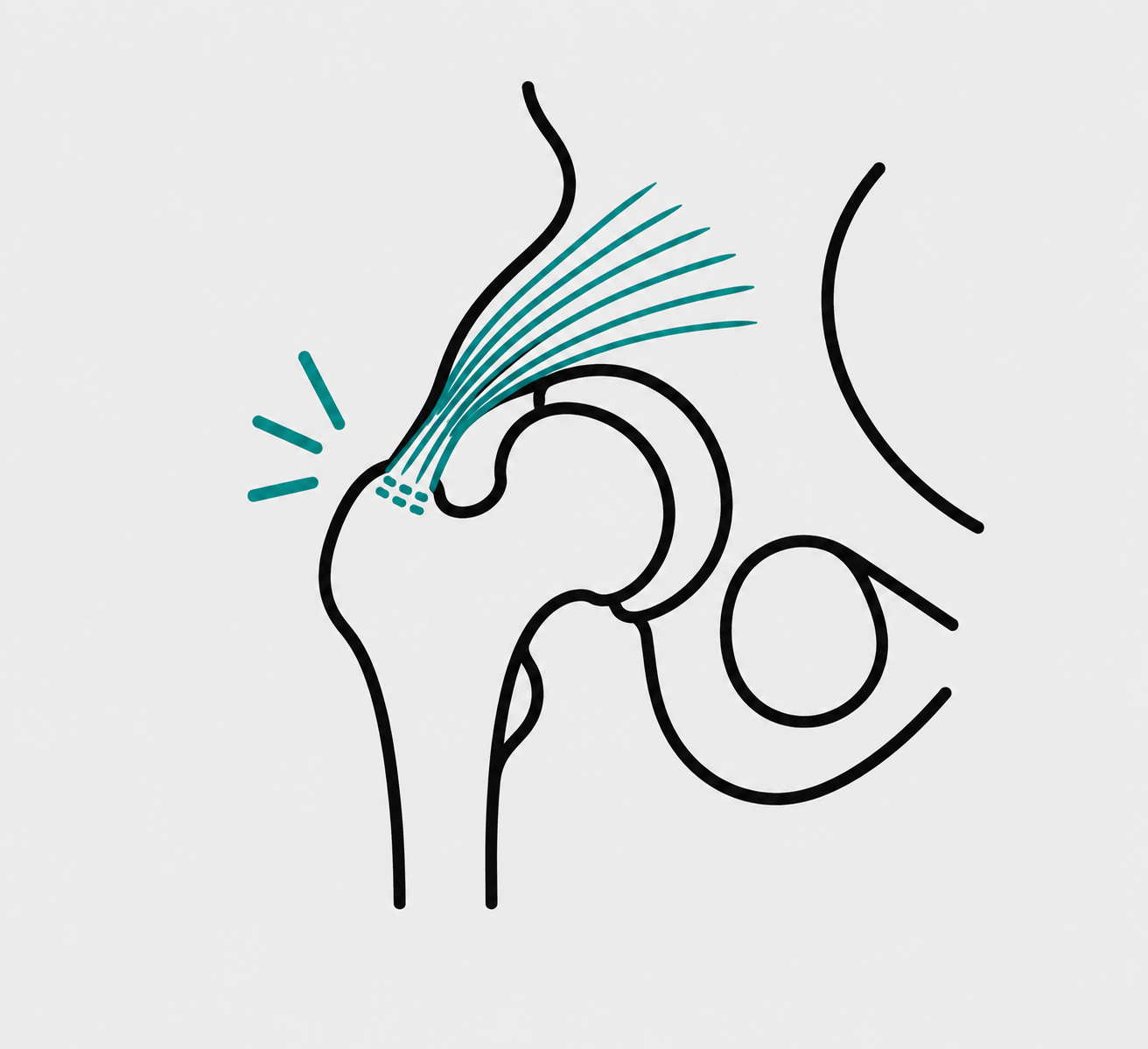 Gluteal Tendinopathy