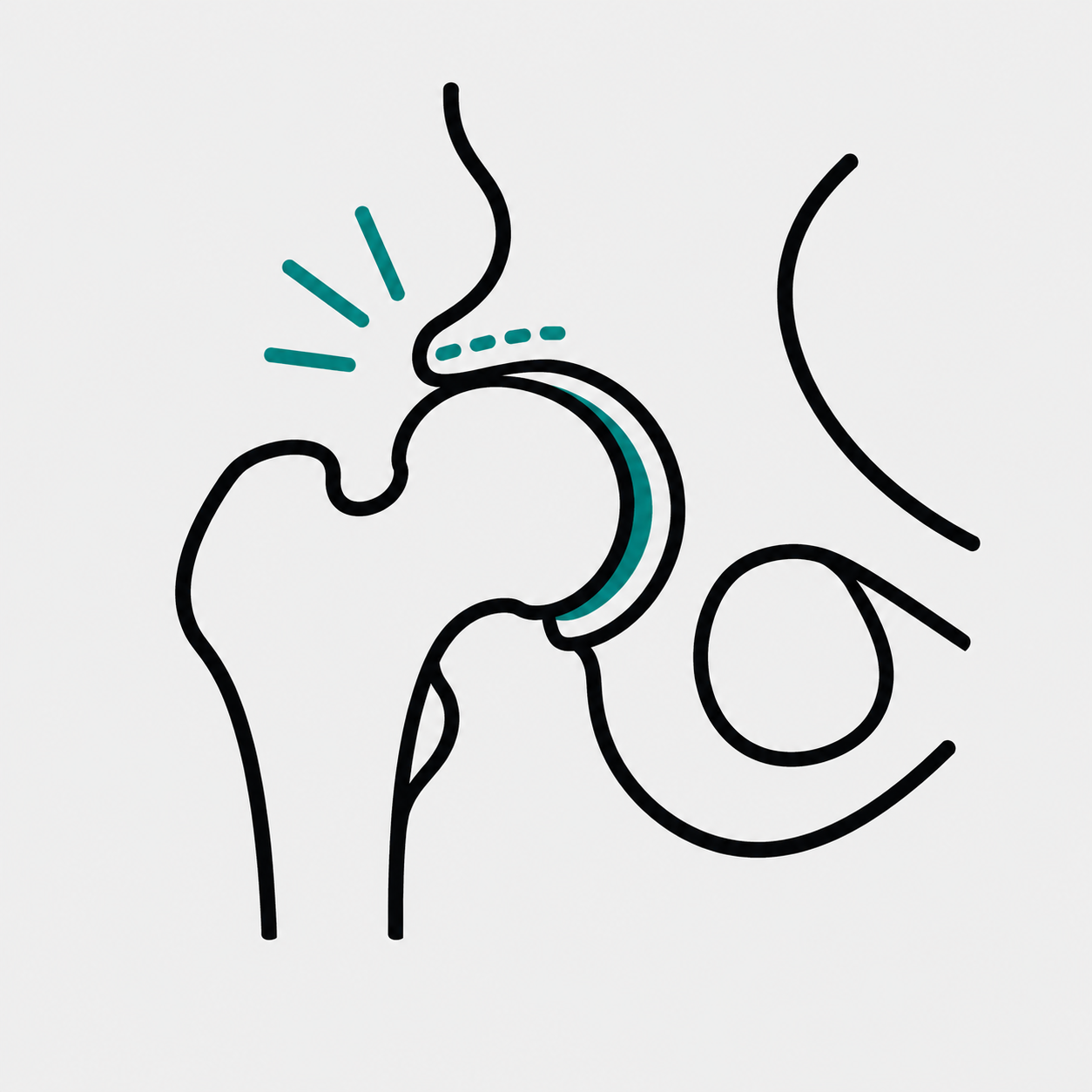 Hip Impingement (FAI)
