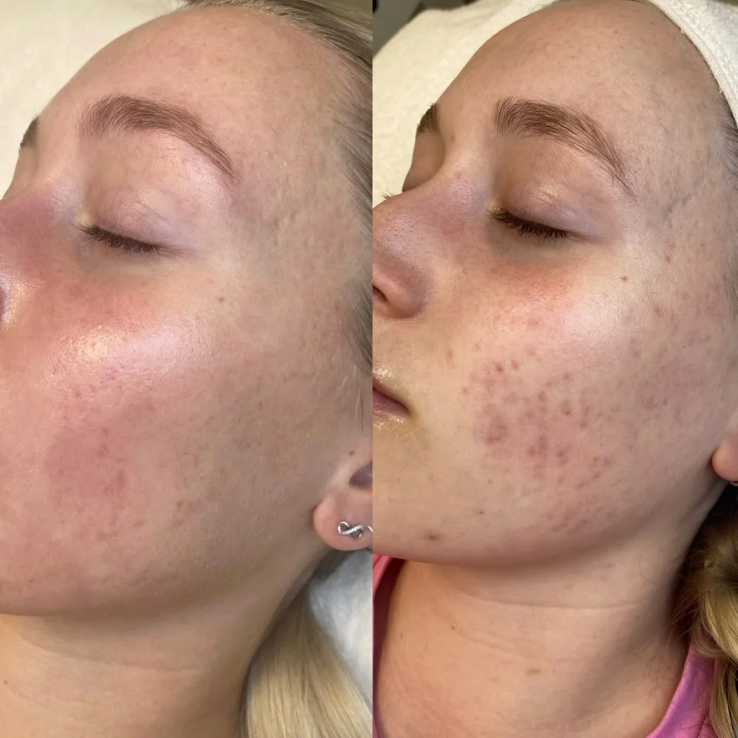 Another amazing before &amp; after result from our dermal needling treatment ✨ Dermal needling is a skin remodeling procedure designed to effectively repair scar damage, reduce fine lines, diminish wrinkles &amp; rejuvenate the skin. 

Right now, we&