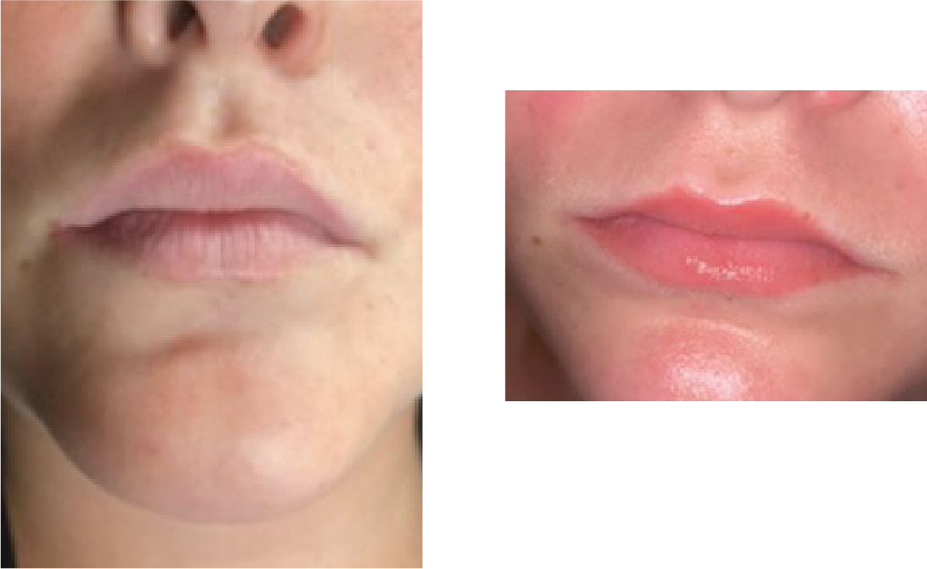 Before & After Template 26 Jul 2026 Lips.png