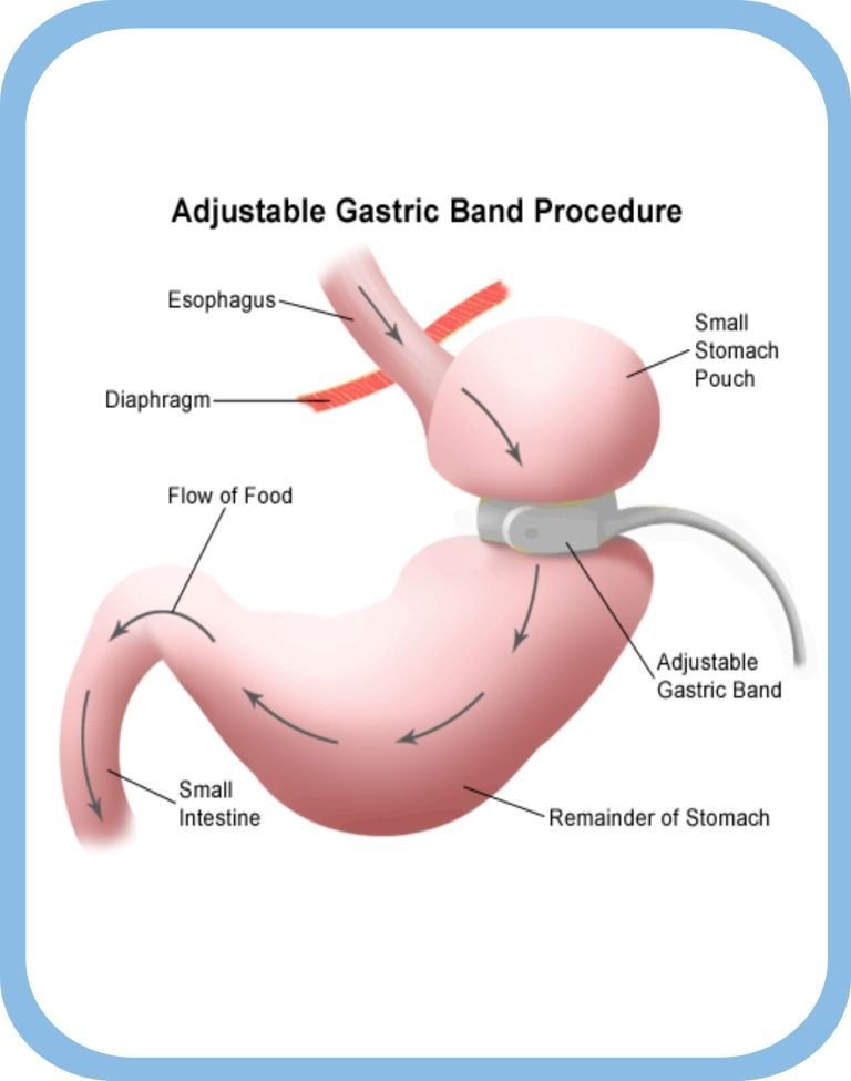 Virtual Gastric Band through hypnosis — Shift Hypnotherapy